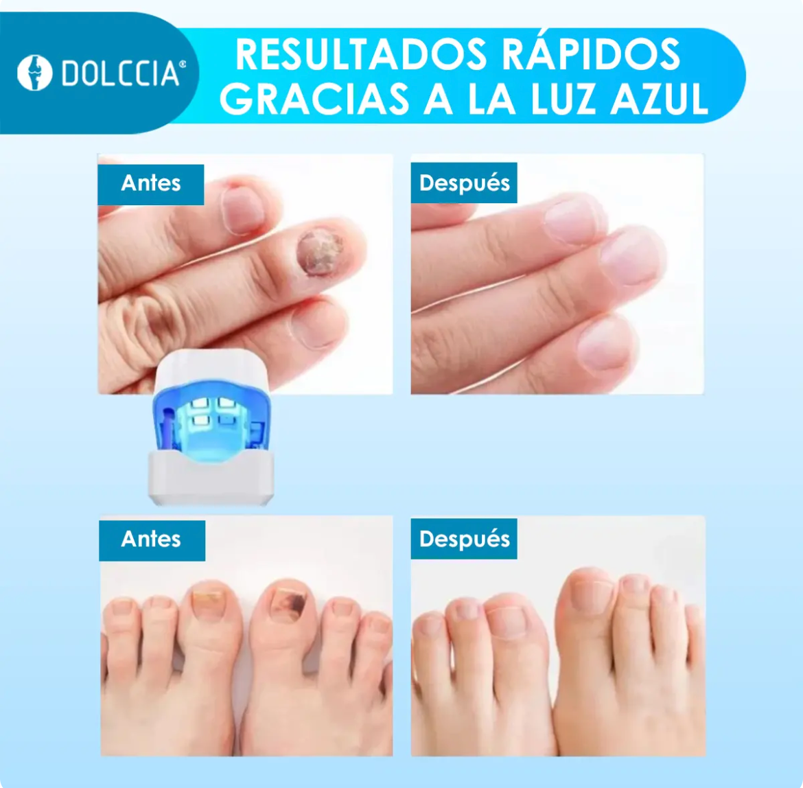 LASER UÑAS DEL PIE DOLCCIA® PROFESIONA OFERTA 2x1 ✅ 🔥